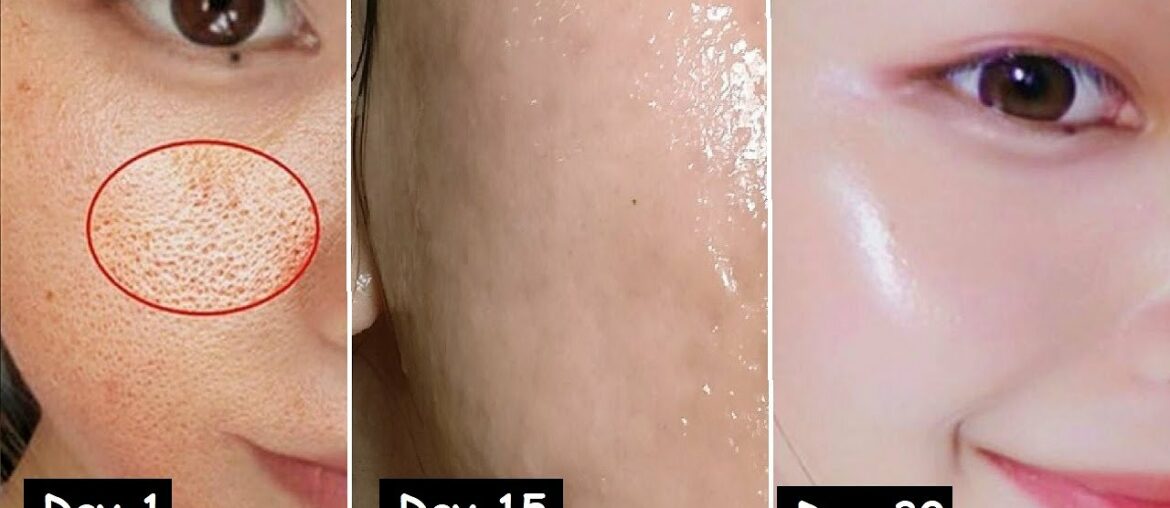 Damaged Skin Repair in 30 Days - Close LARGE OPEN PORES & Remove Dark Spots | Get GLASS Skin