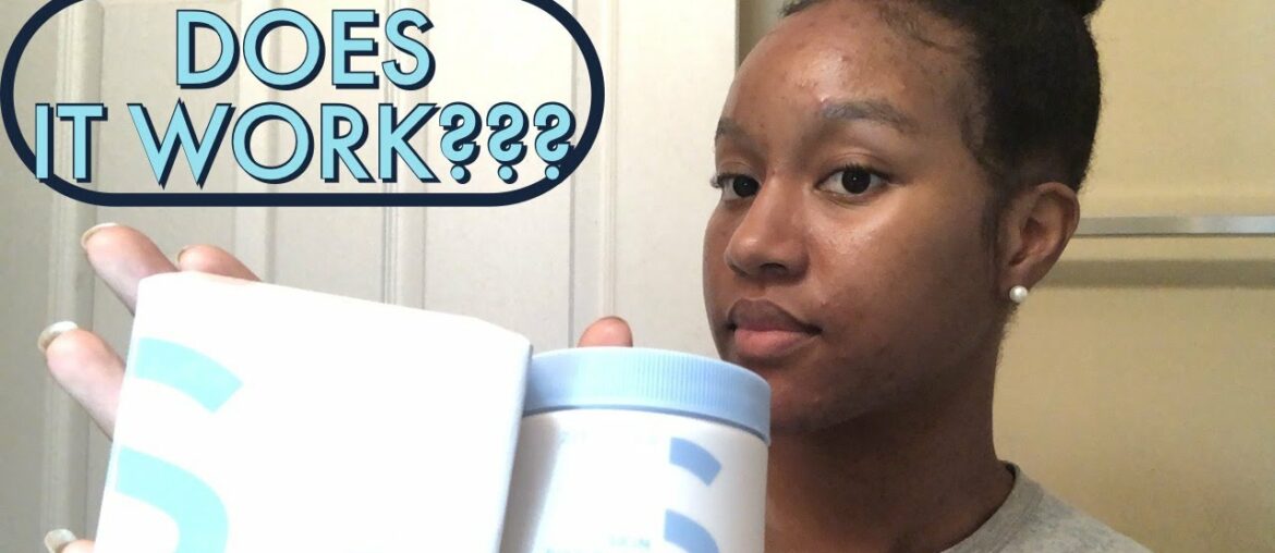 Honest One Month Skin Discipline Review | Zitsticka Vitamin Supplement for Acne | Before and After