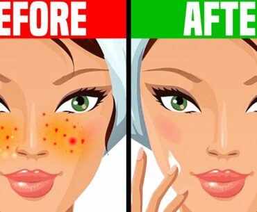 How to Get Rid of Acne OVERNIGHT