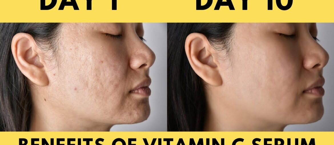 Benefits of Viatmin C serum|Vitamin C serum for glowing and acne free skin