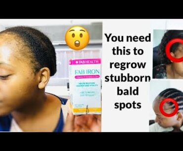 Fab iron + Vitamin B Complex & Zin review ( fab iron tablets regrow) hair vitamins for hair loss