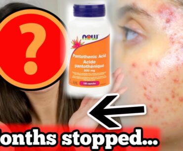 I STOPPED TAKING PANTOTHENIC ACID FOR 5 MONTHS STRAIGHT.. THIS IS WHAT HAPPENED|| Major skin update