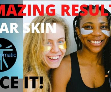 AMAZING CLEAR SKIN & ACNE REMOVAL!