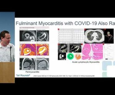 Therapeutics of COVID-19 Induced Myocardial Injury: What we know and what we don't