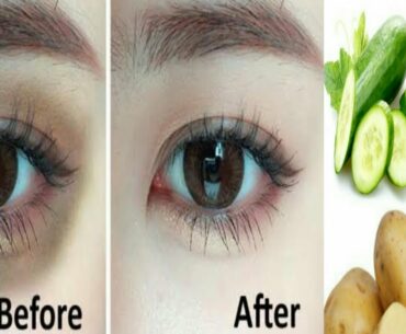 Remove Dark Circles Under Eyes Naturally in 5 Days With Potato, Aloe Vera & Vitamin E !