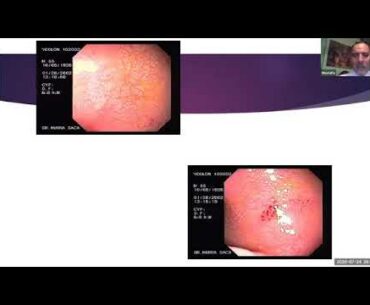 Gut Infections, COVID-19 and NONE. Prof. Mostafa Elhodhod