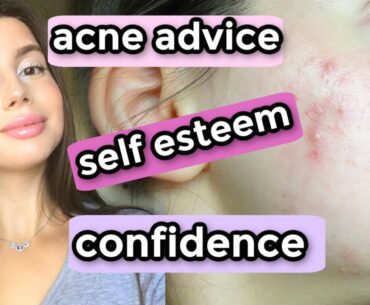 ACNE COVERAGE SCHOOL NATURAL MAKEUP || CHIT CHAT GRWM: School advice, confidence, self esteem