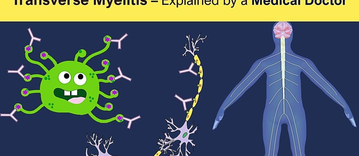 Transverse Myelitis - Culprit behind Oxford COVID-19 vaccine trials halt?