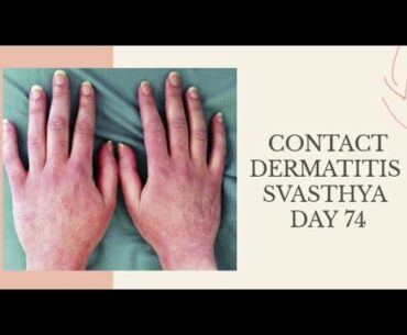 Contact Dermatitis Part-1 I Day- 74