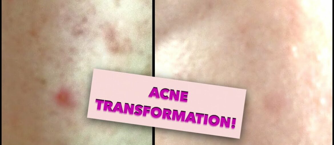 VITAMIN E SOAP  TRANSFORMATION TO PERMANENTLY CURE ACNE!