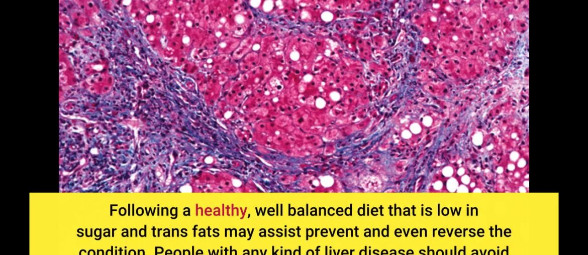 Get This Report about Relation Between Vitamin B12 And Non-alcoholic Fatty Liver