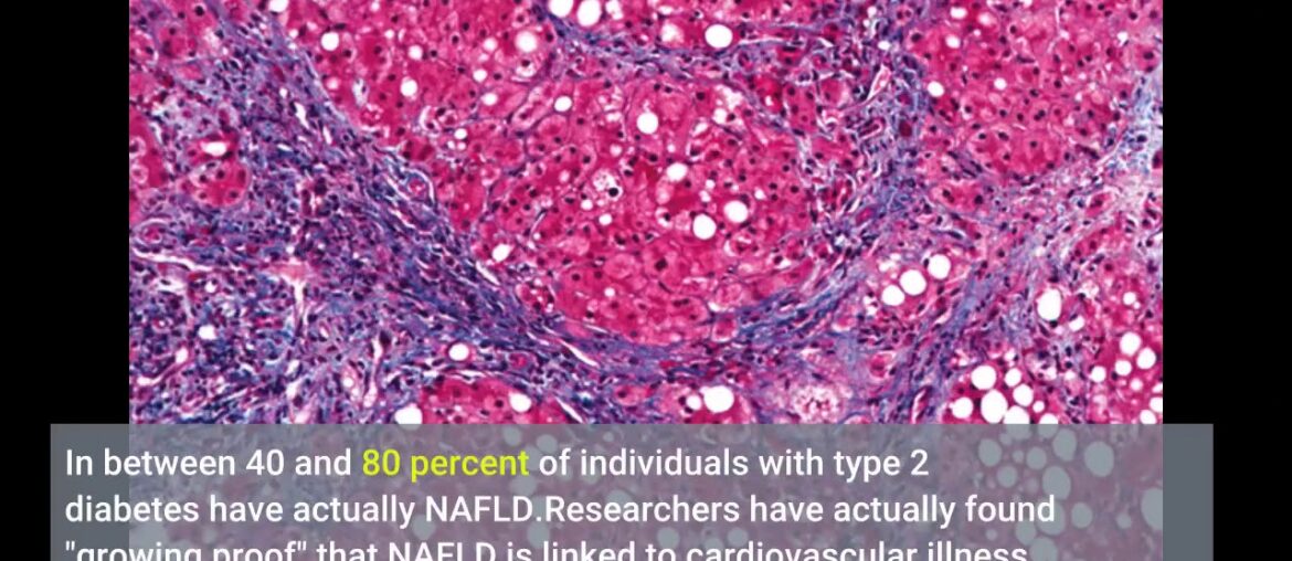 What Does Relation Between Vitamin B12 And Non-alcoholic Fatty Liver Do?