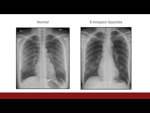 Diagnostic Tests in COVID-19