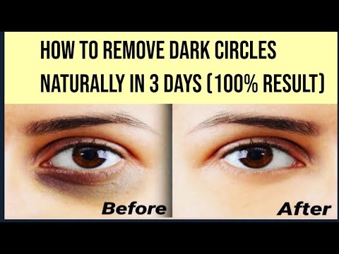 How to Remove Dark Circles Naturally in 3 Days with vitamin E (100% Result)