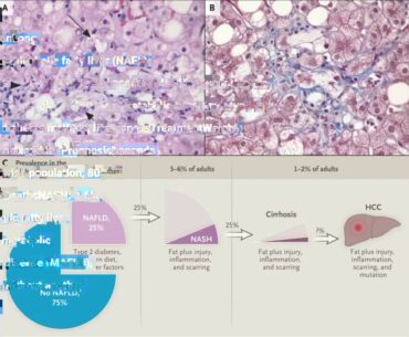 The Basic Principles Of Vitamin D supplementation for nonalcoholic fatty liver disea