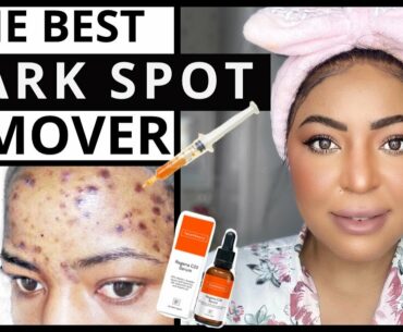 Skincare Game Changer | VITAMIN C For Hyperpigmentation Routine| Dark Spot Remover