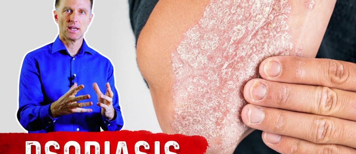 The Best 3 Remedies for Psoriasis