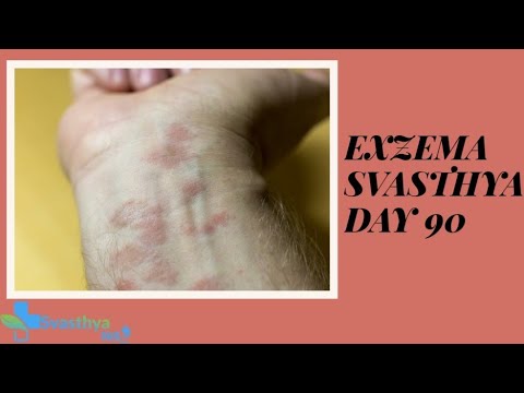 Eczema I Day- 90