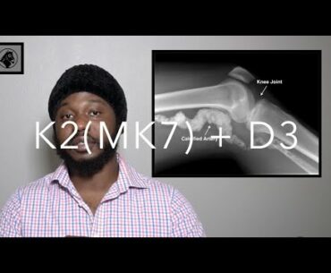 Vitamin K2 MK-7 + Vitamin D ( D3 ) - How Vitamin D Cures Hypertension - Reduce Risk For Coronavirus