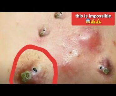 Best blackheads removal | extraction des points noirs | pimple popping video