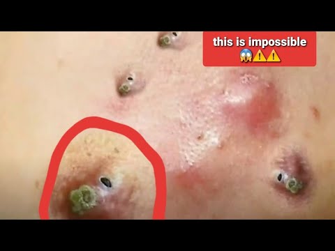 Best blackheads removal | extraction des points noirs | pimple popping video