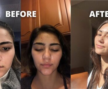 BREAKING OUT NIGHTTIME SKINCARE ROUTINE: Curology, Aztec Healing Clay Mask, The Ordinary & more