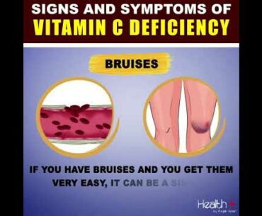 Signs and Symptoms of Vitamin C Deficiency