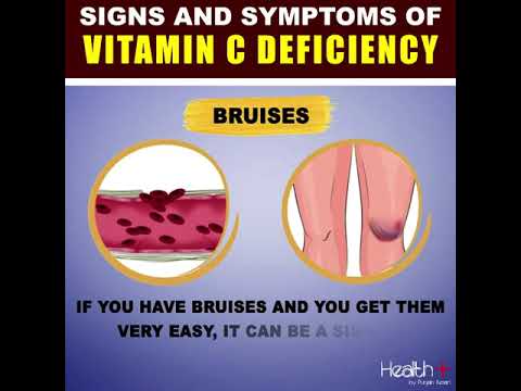 Signs and Symptoms of Vitamin C Deficiency