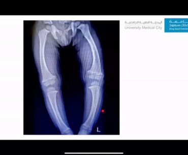 Pediatric Grand Round: Rickets: Beyond Vitamin D Deficiency