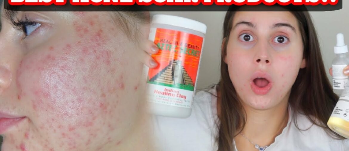 BEST PRODUCTS FOR ACNE SCARS AND SKIN HEALING!!