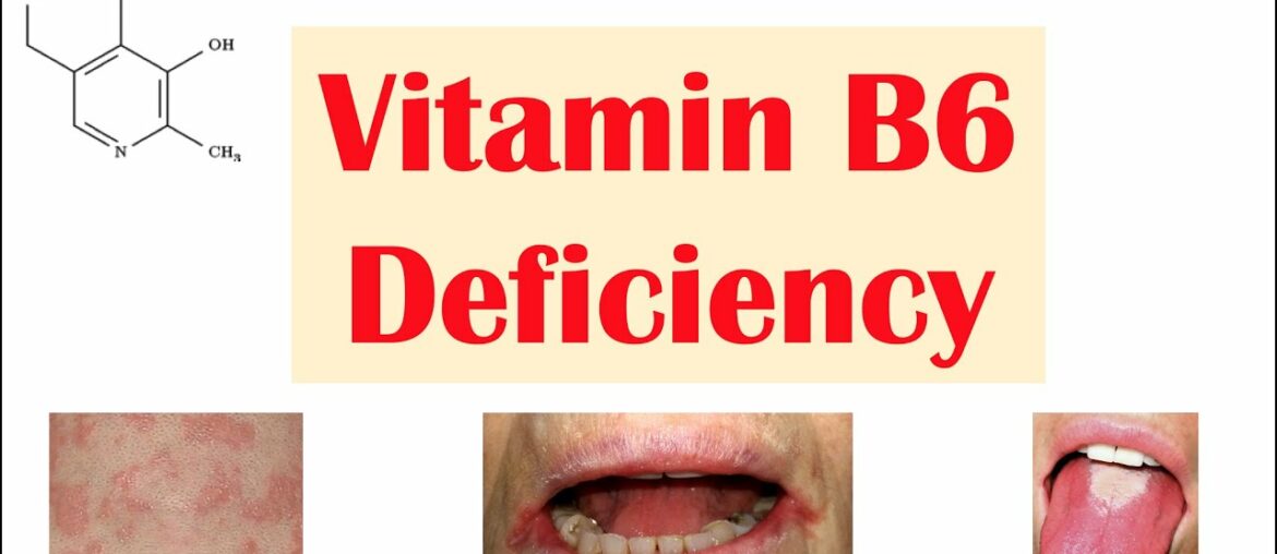 Vitamin B6 (Pyridoxine) Deficiency | Dietary Sources, Causes, Signs & Symptoms, Diagnosis, Treatment