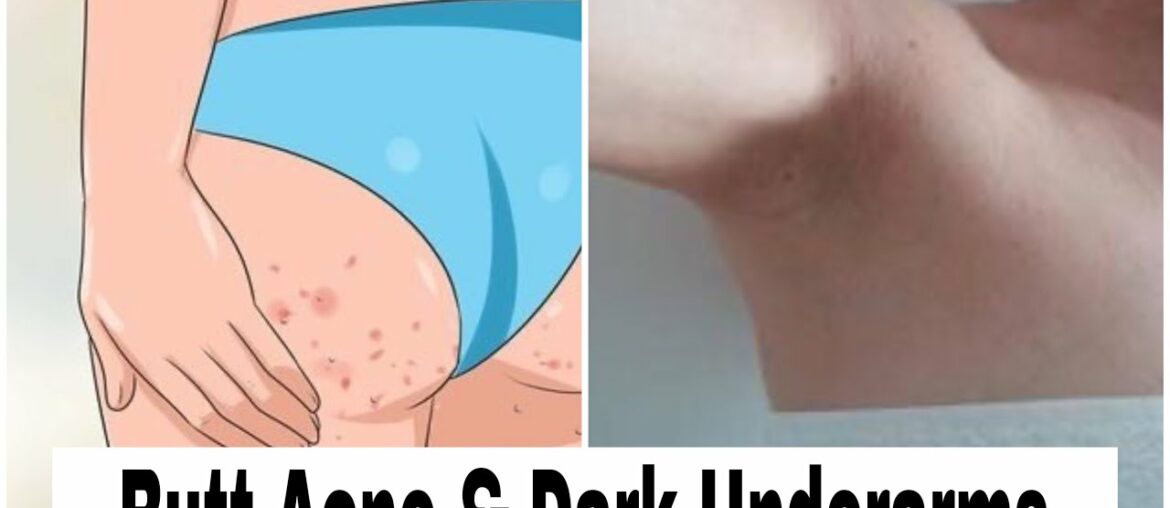 Permanent solution from Butt Acne & Dark Underarms .