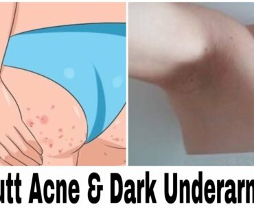 Permanent solution from Butt Acne & Dark Underarms .