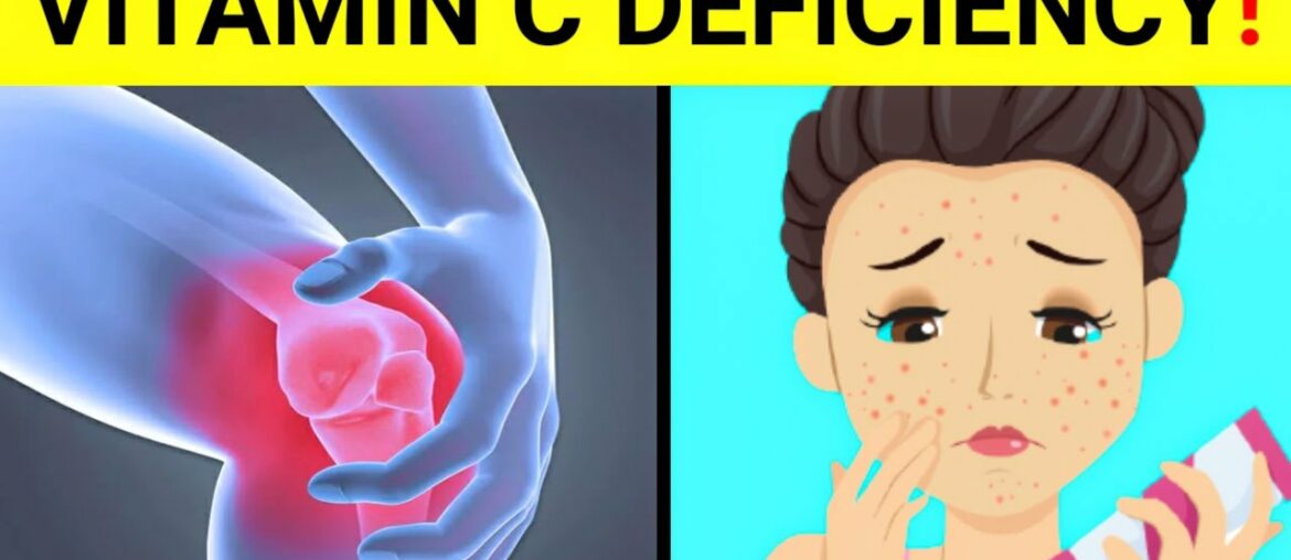 15 Signs And Symptoms Of Vitamin C Deficiency | ( Vitamin C Deficiency )