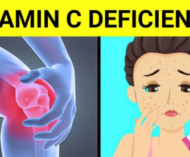 15 Signs And Symptoms Of Vitamin C Deficiency | ( Vitamin C Deficiency )