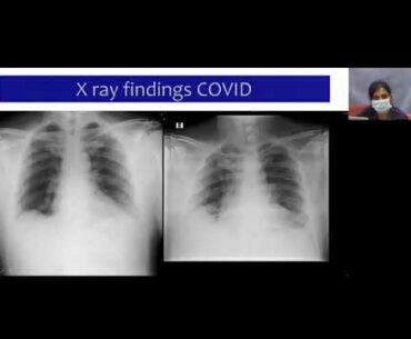 ICU Care in COVID-19 (2 of 3): Management of the critically ill COVID patient