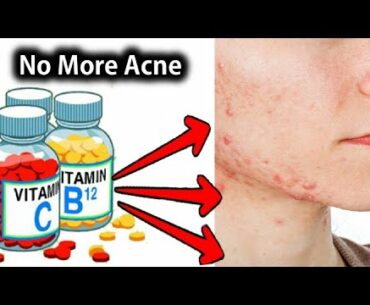 Best Minerals and Vitamins for Acne Treatment