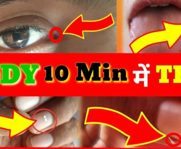 how to check multivitamin deficiency | bleeding gums solution | cracking sound in joints | In Hindi