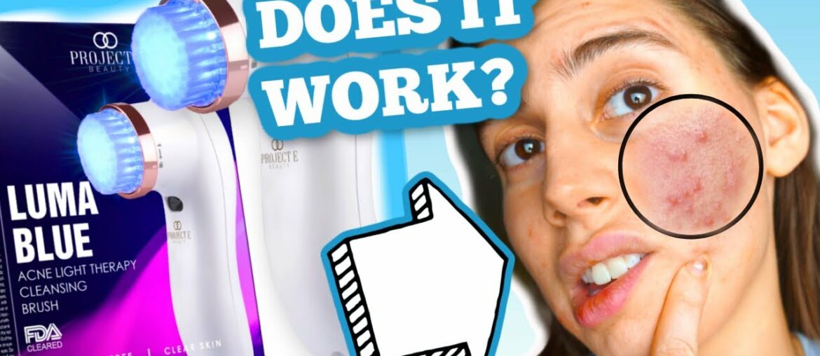 CAN BLUE LIGHT THERAPY HEAL ACNE QUICK?! find out here, literally can't believe it..