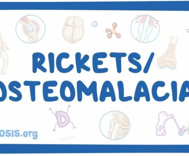 Rickets/osteomalacia - causes, symptoms, diagnosis, treatment, pathology