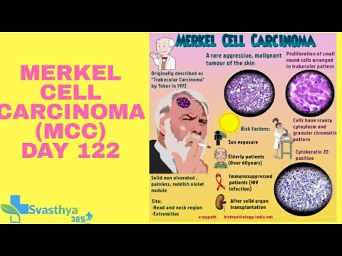 Merkel Cell Carcinoma  I Day-122