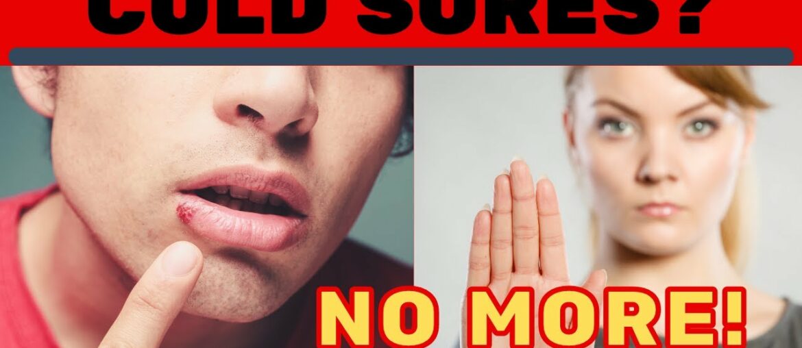 Cold Sores? Get Rid Of Them Today! HSV No More I Nutrition and Natural Remedies