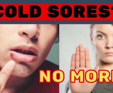 Cold Sores? Get Rid Of Them Today! HSV No More I Nutrition and Natural Remedies