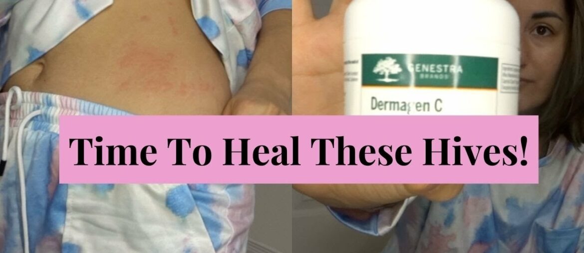 Supplements for Hives | Still breaking out!