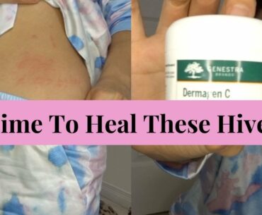 Supplements for Hives | Still breaking out!