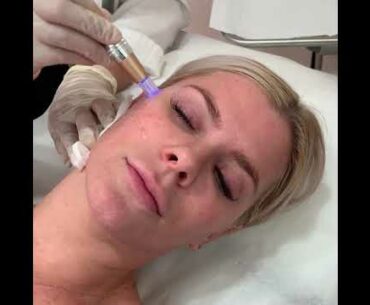 Youth Haus West Hollywood: Microneedling with PRP