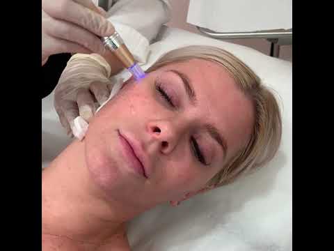 Youth Haus West Hollywood: Microneedling with PRP