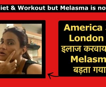 My 15 years of Melasma.Tried everything like good diet, workout, Laser & Peeling but nothing worked.