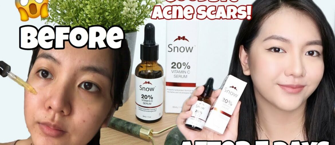 Effective na Acne Scar remover?! | Results after a week | Snow 20% Vitamin C Serum