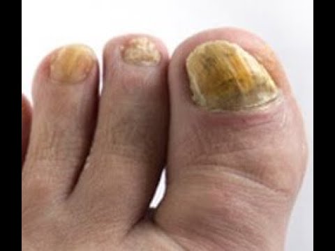 Toe Nail  Fungus De-termination